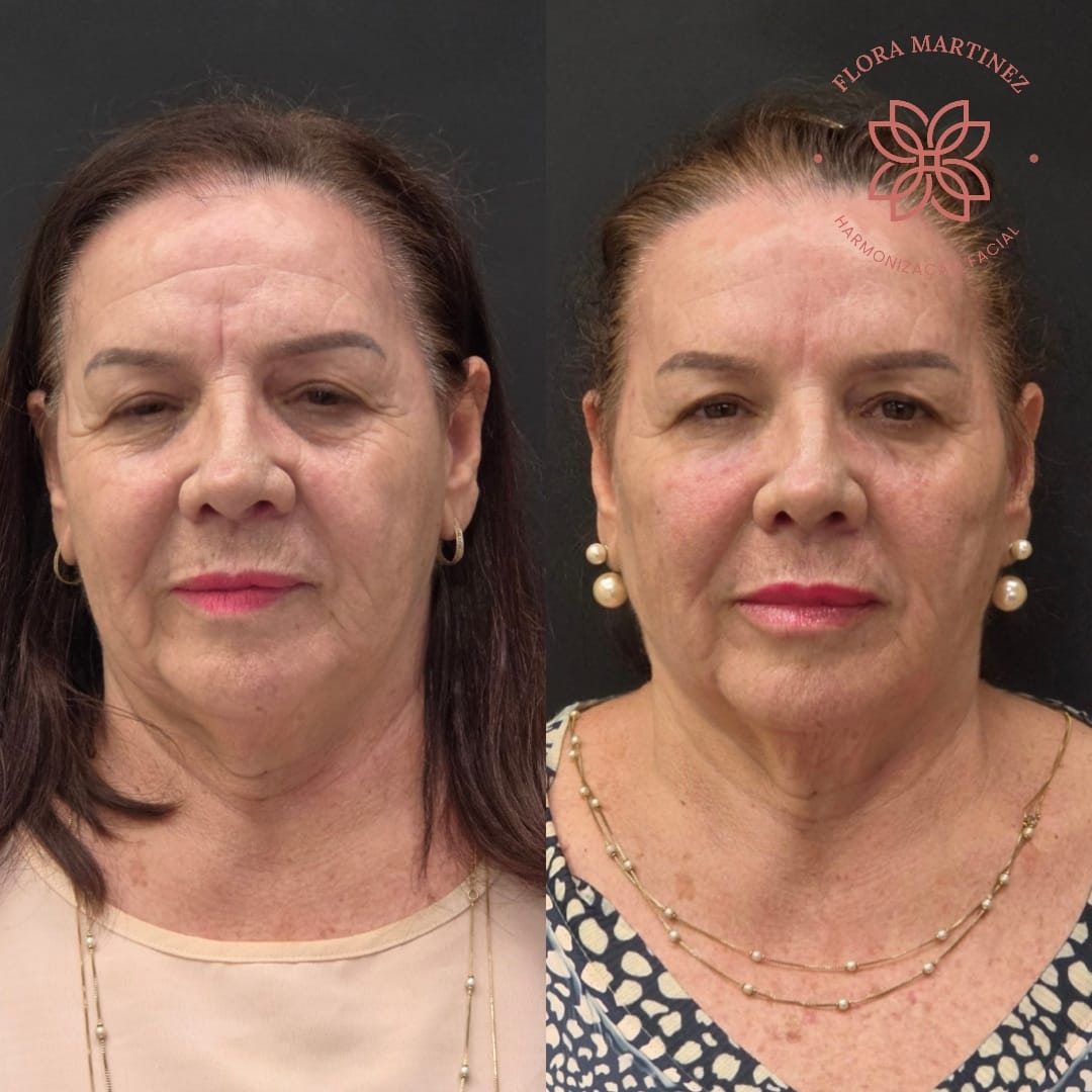 Rejuvenescimento com peptídeos