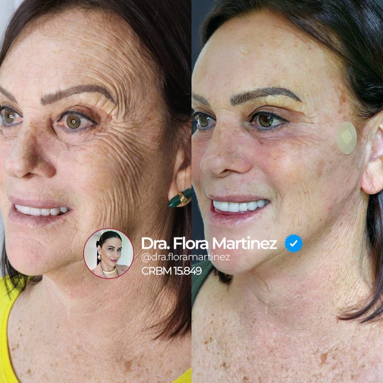 Antes e depois do rosto após tratamento com toxina botulínica, bioestimulador de colágeno (HarmonyCa) e preenchimento com ácido hialurônico (Restylane).