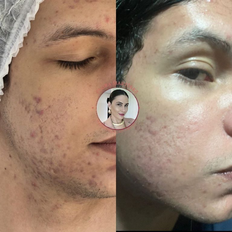 Antes e depois de tratamento para acne facial