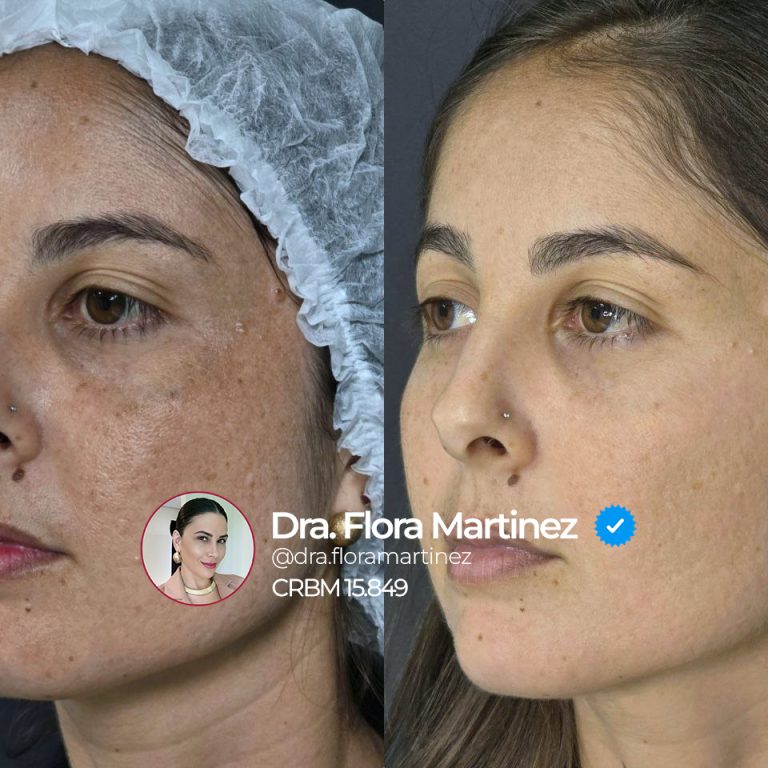 Antes e depois de tratamento para melasma