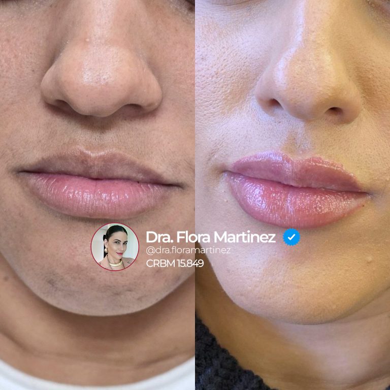 Antes e depois de preenchimento labial