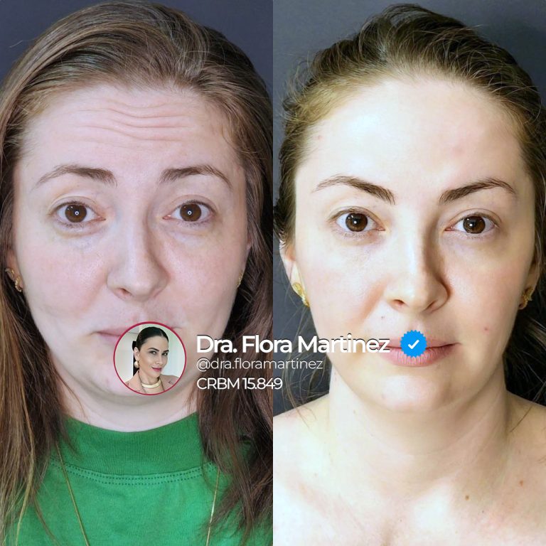 Antes e depois de harmonização facial