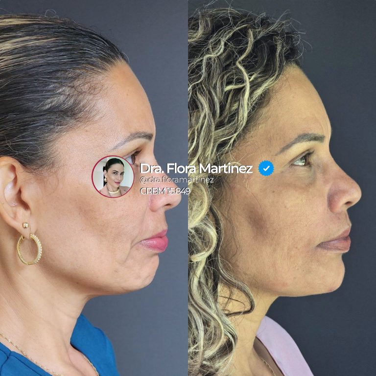 Antes e depois de harmonização facial em perfil