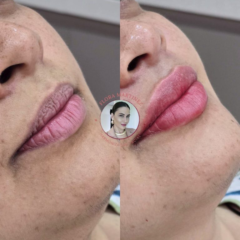 Antes e depois de preenchimento labial