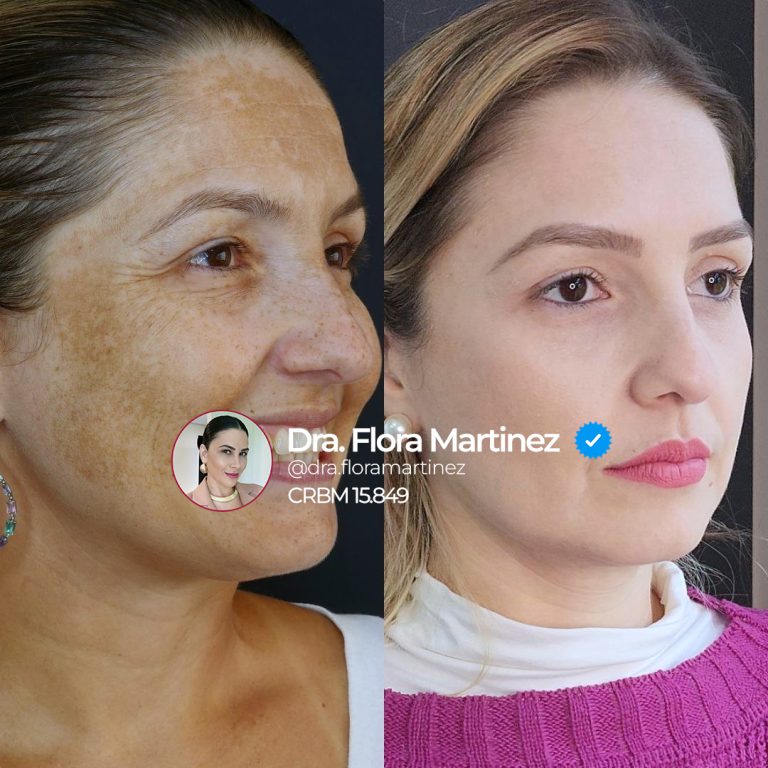 Antes e depois de tratamento para melasma