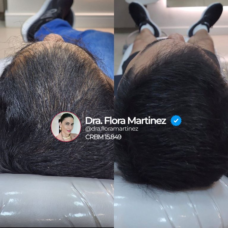 Antes e depois de tratamento capilar no topo da cabeça