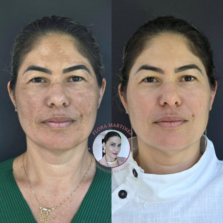 Antes e depois de tratamento para melasma
