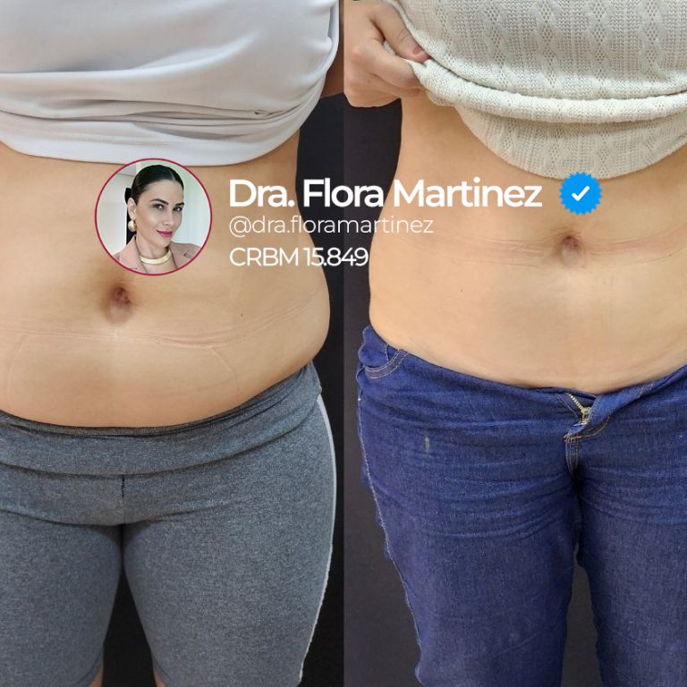 Antes e depois de tratamento corporal abdominal
