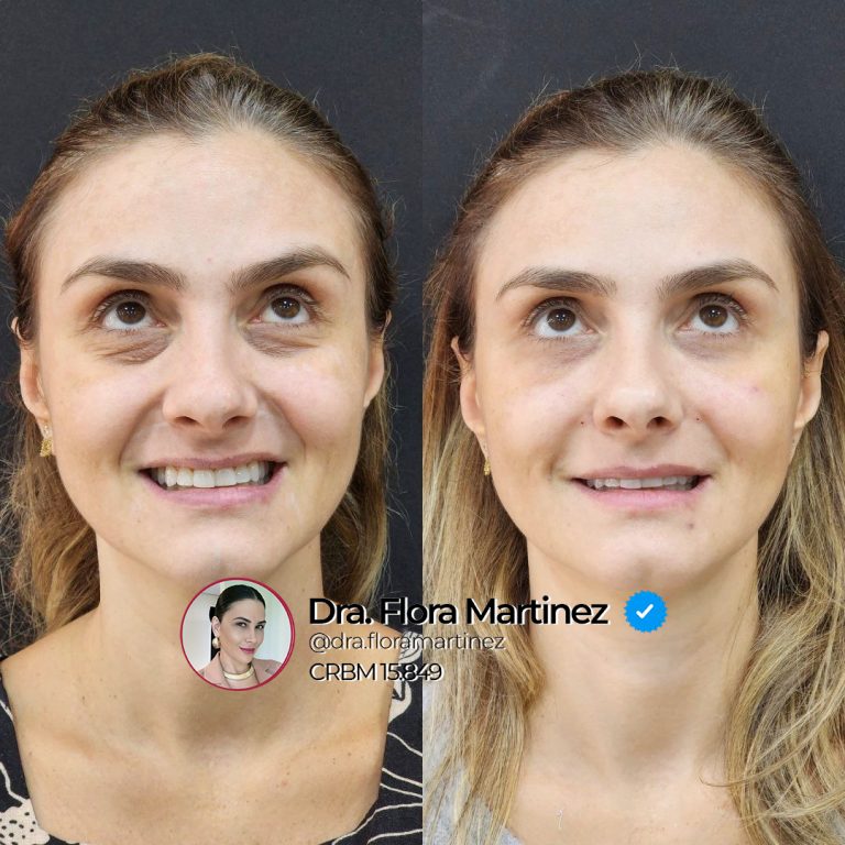 Antes e depois de rejuvenescimento da região dos olhos