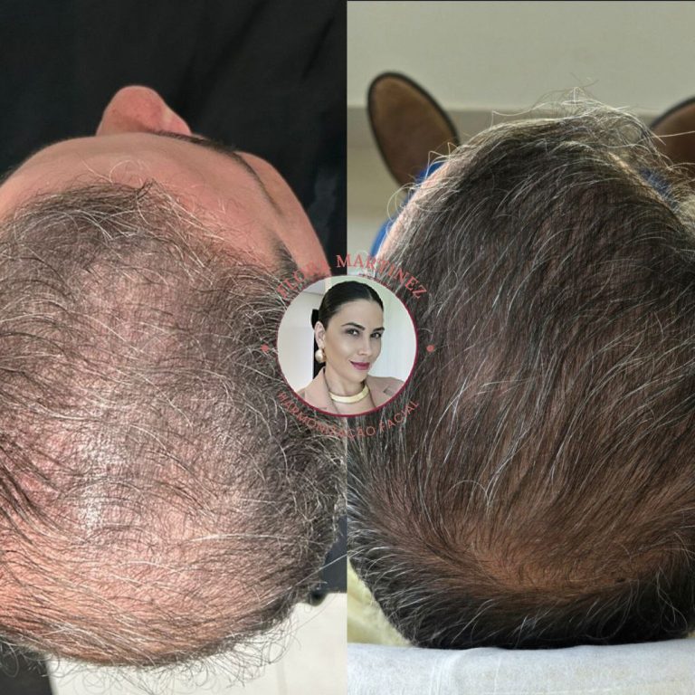 Antes e depois de tratamento capilar